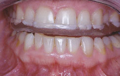 Bruxisme dentaire. Vos dents sont-elles usées? Dentiste Touchette à Gatineau