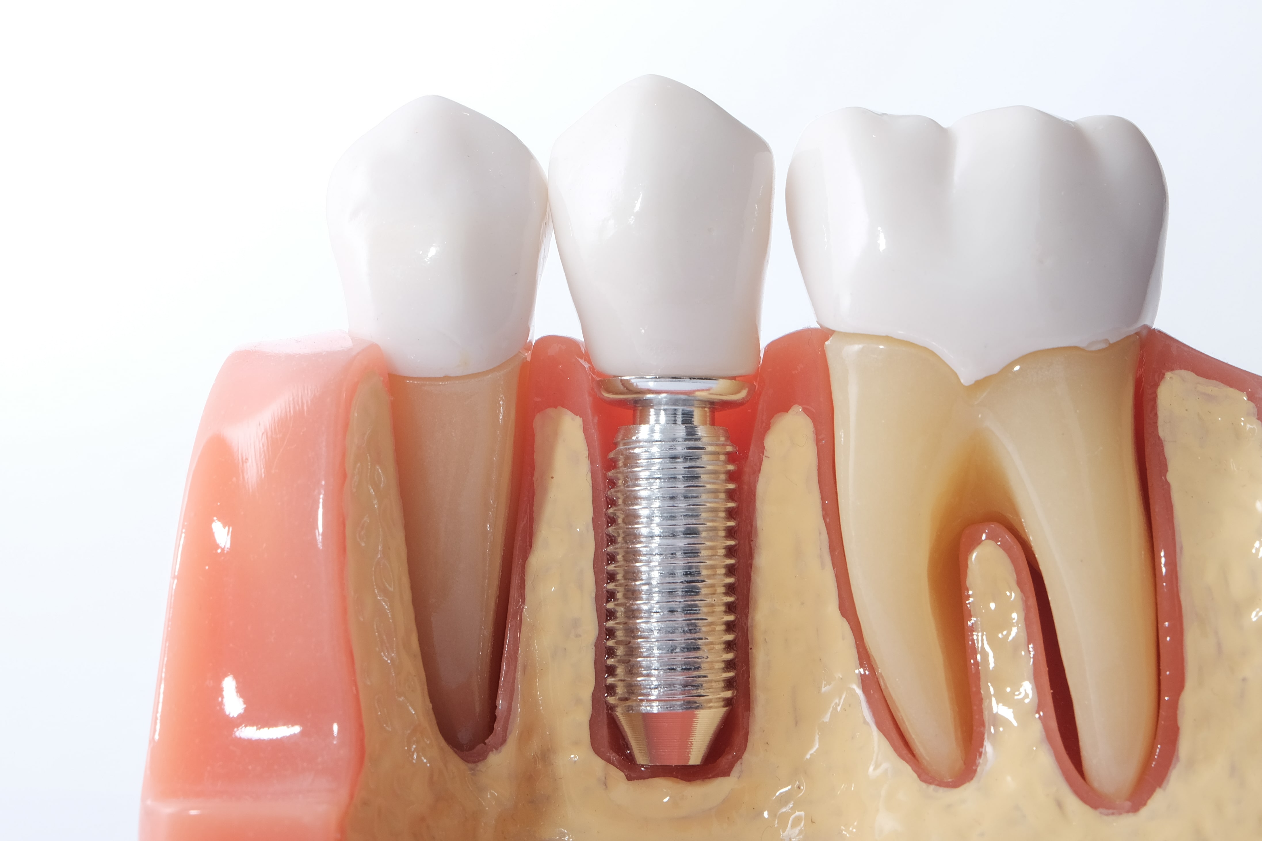 Ce que vous devez savoir sur les implants dentaires