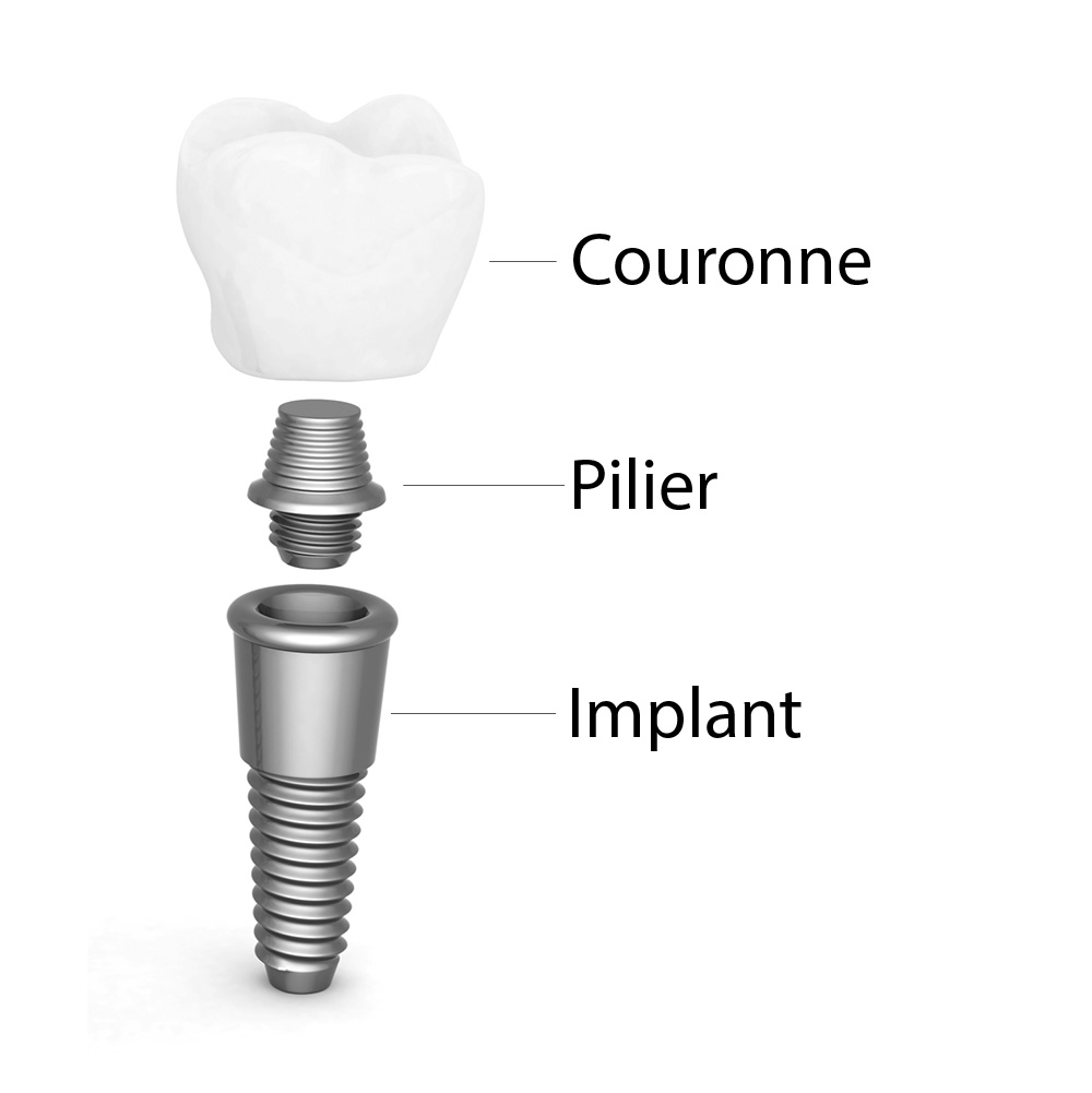 La couronne sur implant dentaire - Dentiste Touchette à Gatineau 