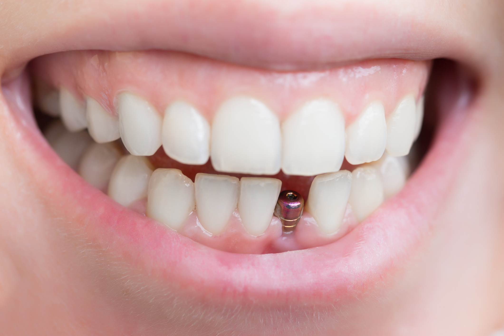 Dental implant - Dr Pierre Hayek