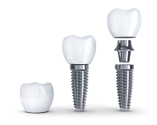 The crown on a dental implant - Dentiste Touchette in Gatineau