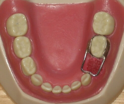 Qu'est ce que le mainteneur d'espace dentaire?