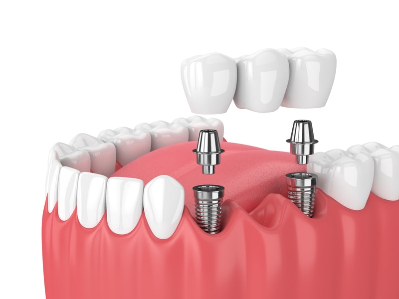 Le pont fixe sur implant - Dentistes Touchette
