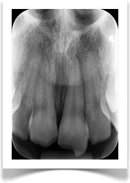 La radiographie - Dentiste Touchette à Gatineau