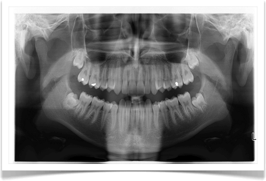 Radiographie panoramique - Dentiste Touchette à Gatineau